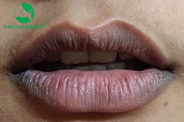 Khử thâm môi có lên màu không? Bao lâu lên màu? 2 Khử môi thâm có lên màu không?