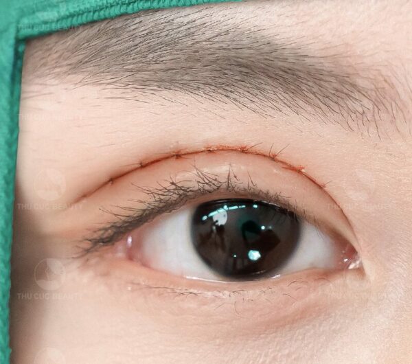 Lấy mõ mí mắt trên giúp mí rõ nét và đẹp hơn.