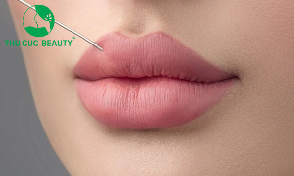 Tiêm filler dáng môi tây cánh én