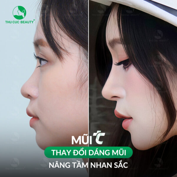 Nâng mũi giúp nhan sắc thăng hạng