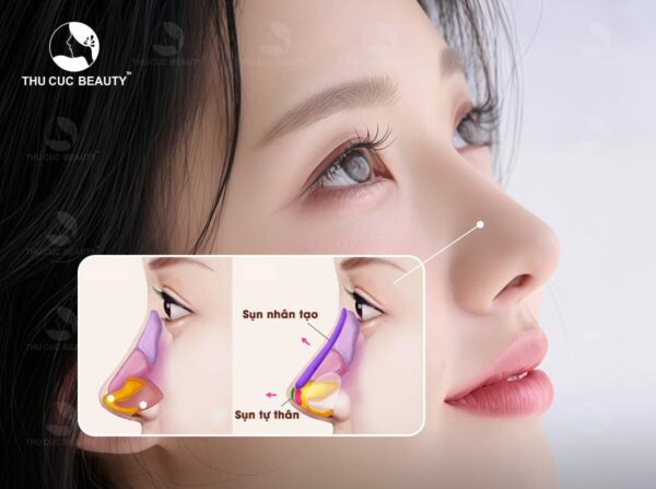 Bọc sụn đầu mũi giúp mũi đẹp tự nhiên và bền lâu hơn.