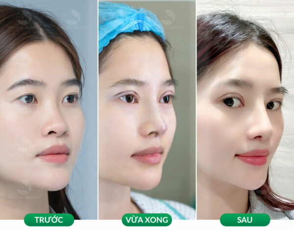 Nâng mũi gom lại có bị thấp không?