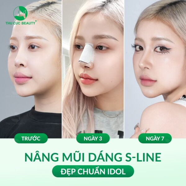 Nâng mũi S-line giữ được bao lâu? 2 Nâng mũi S-line rất được ưa chuộng hiện nay.
