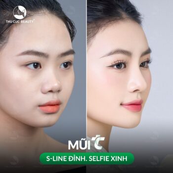 Nâng mũi S-line giữ được bao lâu?
