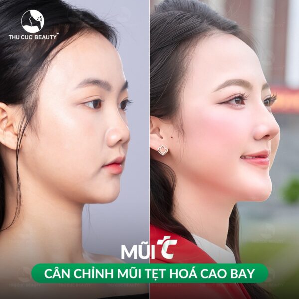 Nâng mũi S-line giá bao nhiêu?