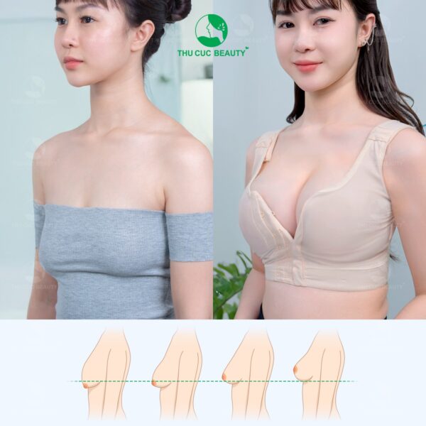 Nâng ngực chảy xệ giá bao nhiêu?