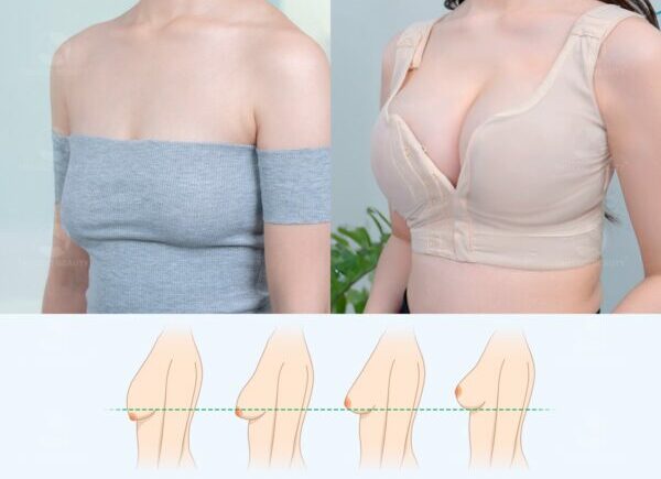 Nâng ngực chảy xệ kết hợp đặt túi sẽ cho hiệu quả tối ưu hơn, bền lâu và tạo bầu ngực đẹp.