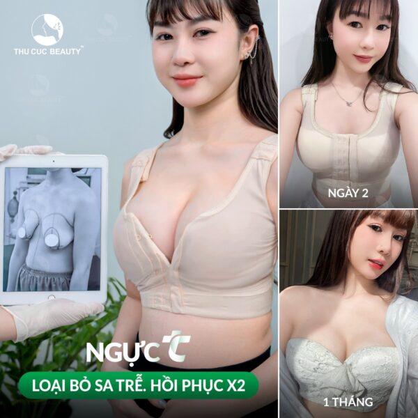 Nâng ngực chảy xệ giá bao nhiêu?