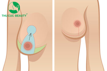 Nâng ngực chảy xệ không đặt túi có được không?