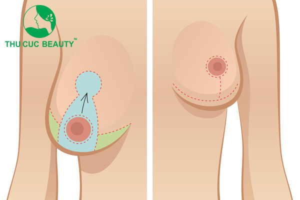 Nâng ngực chảy xệ không đặt túi vẫn có thể thực hiện bình thường.
