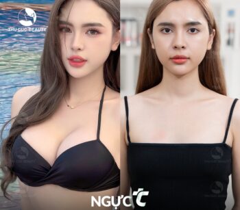 Cập nhật bảng giá nâng ngực mới 2026