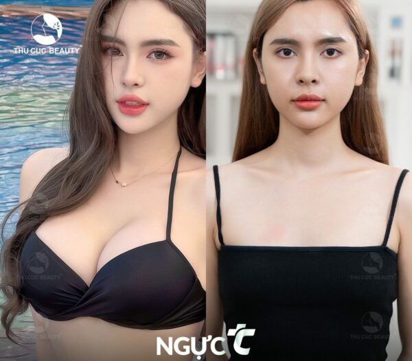 Cập nhật bảng giá nâng ngực mới 2026