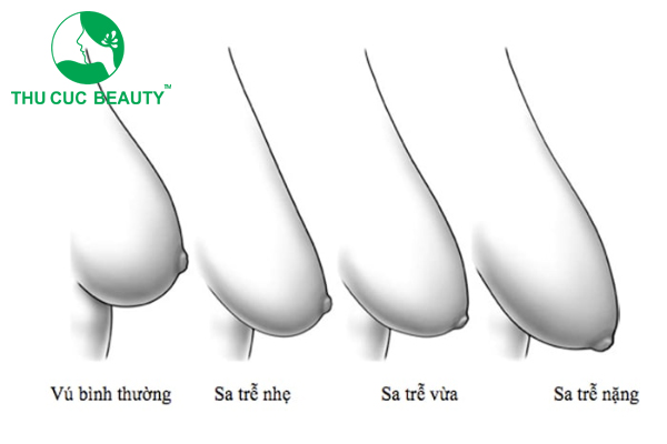 Nâng ngực chảy xệ không đặt túi.