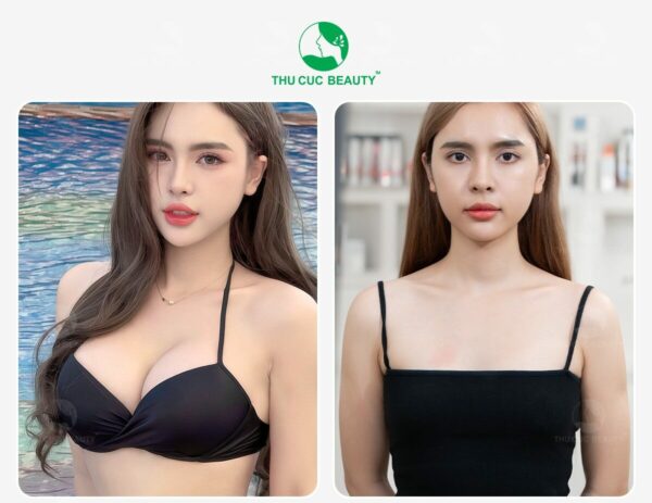 phau thuat nang nguc e1767931508683