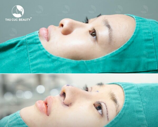 Thu gọn cánh mũi có được vĩnh viễn không? 1 Thu gọn cánh mũi có được vĩnh viễn không?