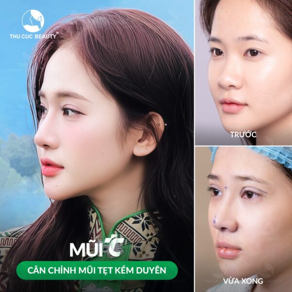 Thu gọn cánh mũi có được vĩnh viễn không? 2 Thu gọn cánh mũi có được vĩnh viễn không?