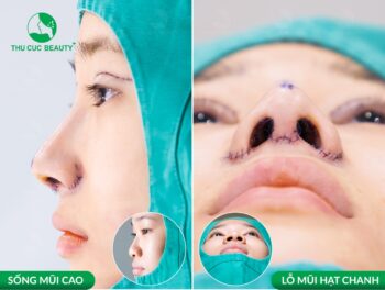 Thu gọn cánh mũi có được vĩnh viễn không?