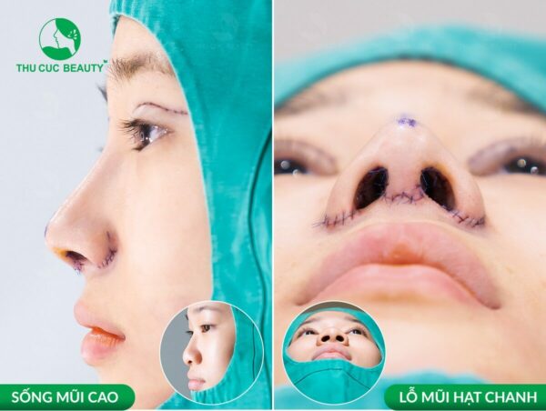 Thu gọn cánh mũi có được vĩnh viễn không? 3 Thu gọn cánh mũi có được vĩnh viễn không?