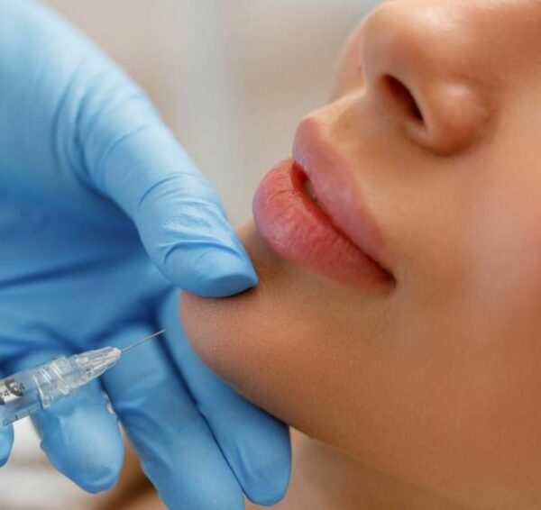Tiêm filler môi bao lâu thì vào form?