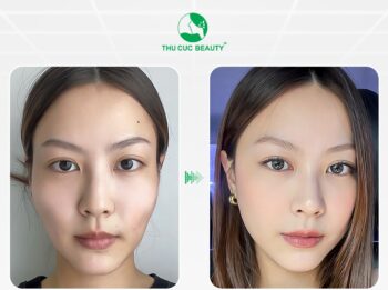 Tiêm filler má bao nhiêu tiền? Tiêm ở đâu uy tín?