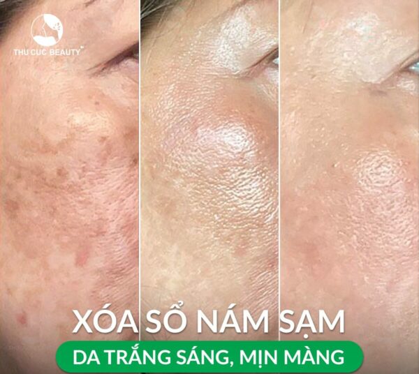 Trị nám da có hết vĩnh viễn không?