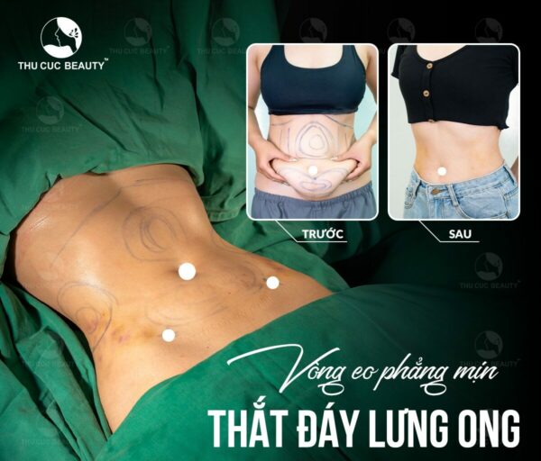 Hút mỡ bụng để nâng vòng 3 được không? 2 Ưu điểm của hút mỡ bụng để nâng vòng 3.