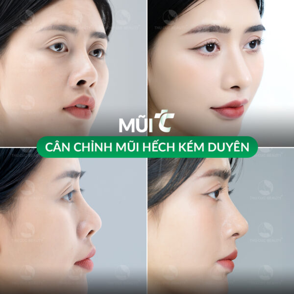 Nâng mũi cấu trúc là phương pháp khắc phục mũi hếch hiệu quả.