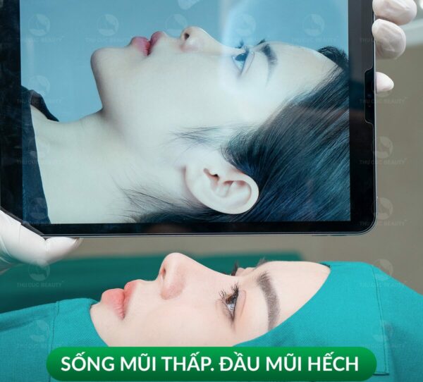 Chỉnh sửa mũi hếch thẩm mỹ tại Thu Cúc.