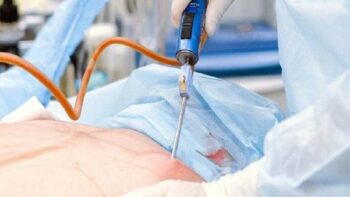 Tại sao khi hút mỡ không nên hút kiệt?