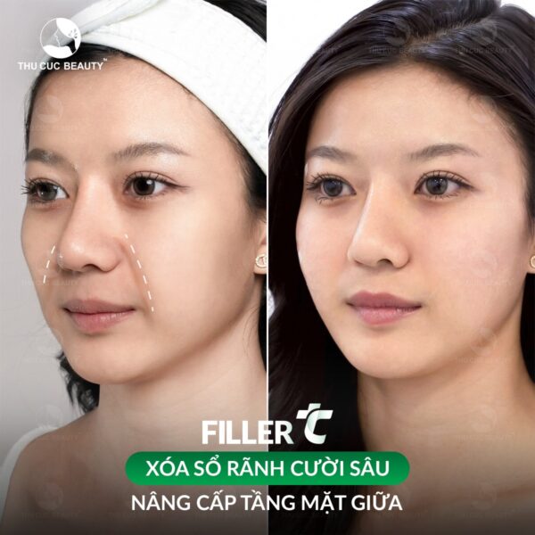 tiem filler e1770794310566