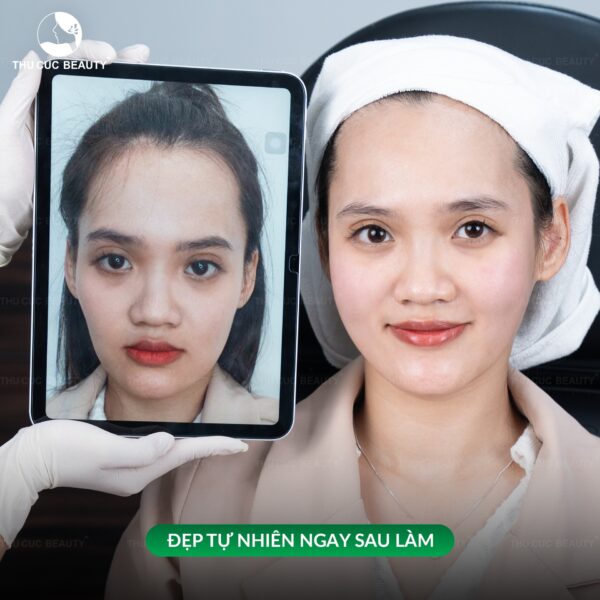 Sau khi tiêm filler có được thực hiện nâng cơ không?