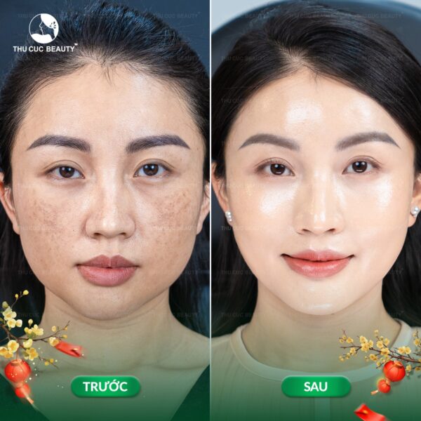 Tiêm meso hiệu quả trong khoảng 6 - 12 tháng.