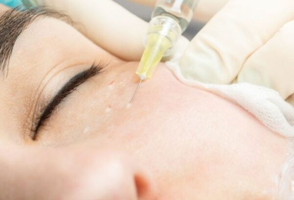 Trị thâm mắt bằng phương pháp nào hiệu quả? 2 Tiêm trị thâm quầng mắt đem lại hiệu quả cao.