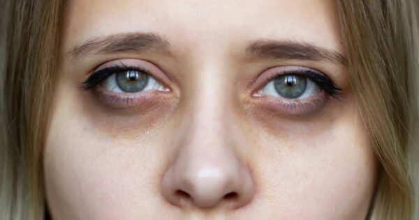 Trị thâm mắt bằng phương pháp nào hiệu quả? 1 Nguyên nhân gây thâm quầng mắt