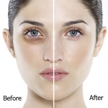 Trị thâm mắt bằng phương pháp nào hiệu quả?