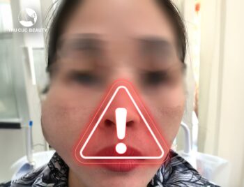 Các dấu hiệu cảnh báo cần tiêm tan filler ngay