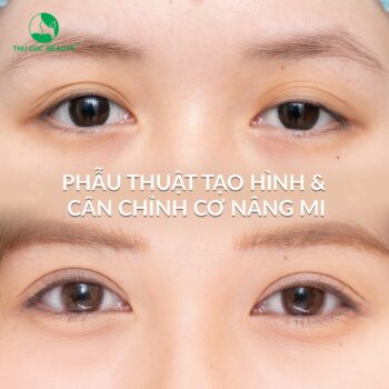 Sụp mí có cắt mí mắt được không? Cần lưu ý những gì?