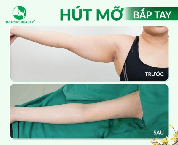Hút mỡ bắp tay an toàn tại BVTM Thu Cúc
