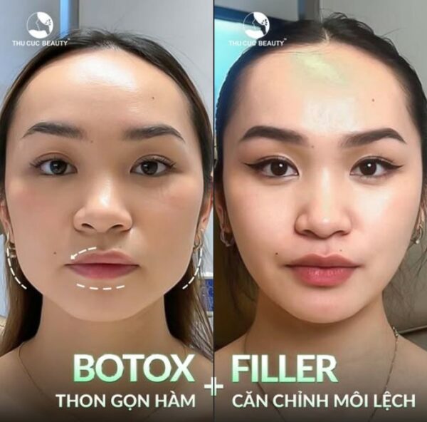 Tiêm botox gọn hàm kết hợp cùng tiêm filler