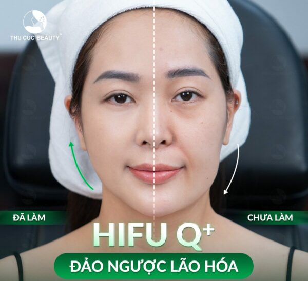 nang co HIFU la gi e1774685360535