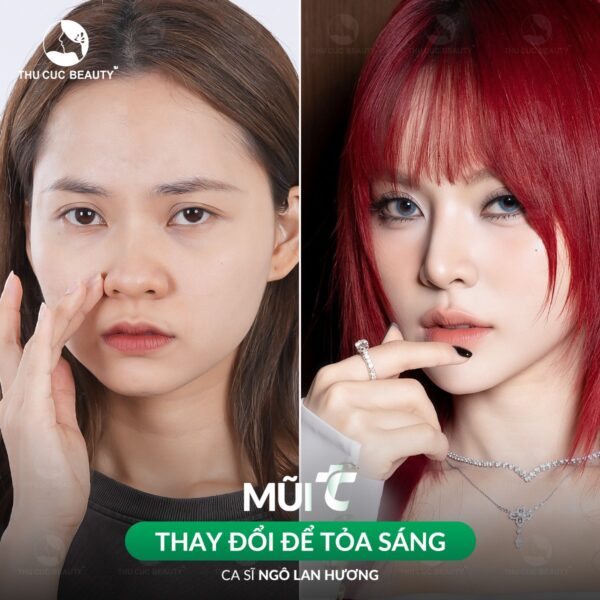 Nâng mũi sụn Surgiform bao nhiêu tiền? 3 nang mui dep e1772613064251