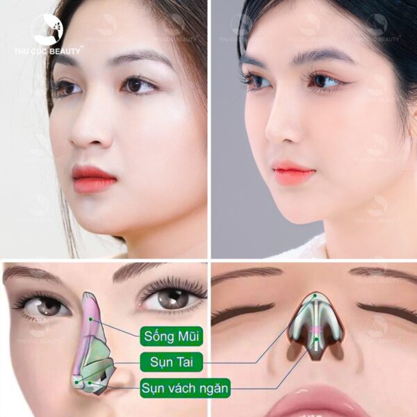 nang mui khong can thiep dau mui e1773222049770