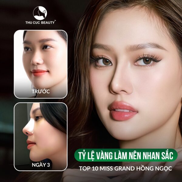 Nâng mũi sụn Surgiform bao nhiêu tiền? 1 Nâng mũi sụn Surgiform cho vẻ đẹp tự nhiên, thanh thoát.