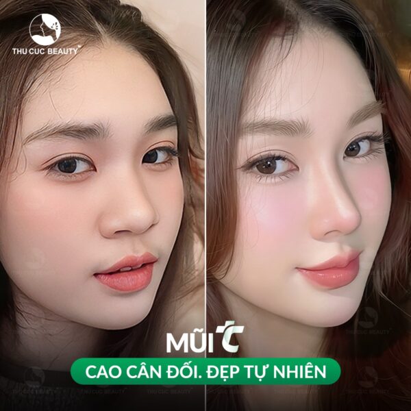 Nâng mũi sụn Surgiform bao nhiêu tiền? 2 Nâng mũi sụn Surgiform giá bao nhiêu?