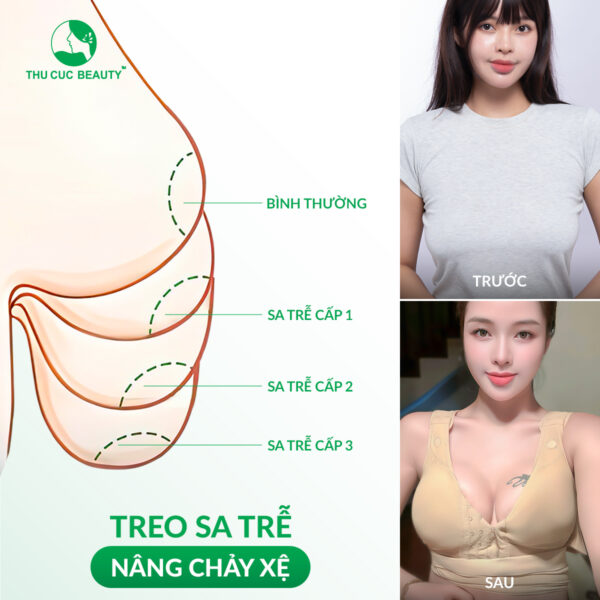 Treo ngực sa trễ kết hợp đặt túi độn tối ưu tính thẩm mỹ.
