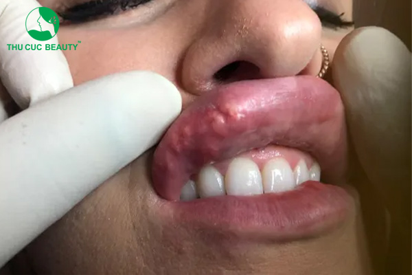 noi u hat sau tiem filler