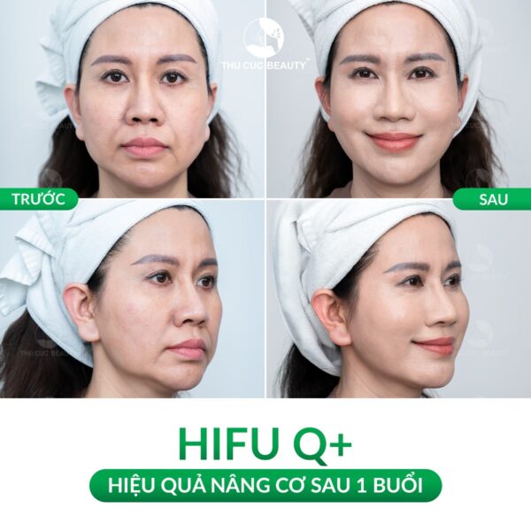 Cải thiện rãnh cười sâu hiệu quả, nâng cơ mặt bằng công nghệ HIFU Q+