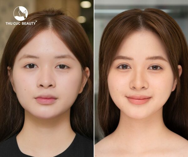 Sụp mí có cắt mí được không?