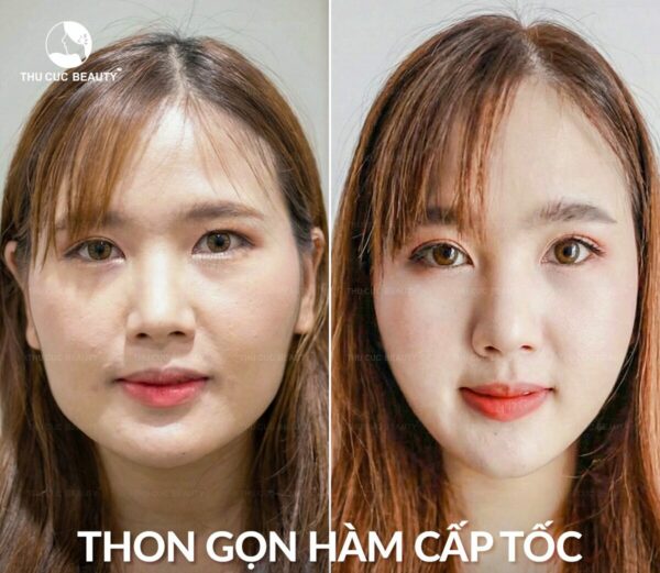 Tiêm botox gọn hàm và những điều cần biết
