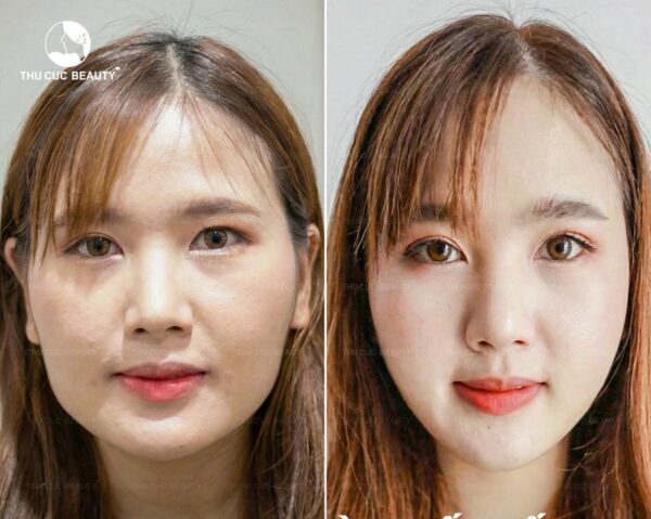 Tiêm botox giúp gương mặt thon nhỏ hiệu quả.